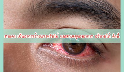 ตาแดง เป็นอาการร้ายแรงหรือไม่ และสาเหตุของอาการ อธิบายได้ ดังนี้